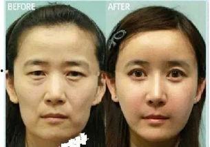 爆料整容诈骗案例最新,受害者血泪教训，警惕美丽陷阱